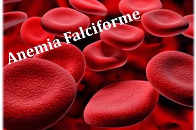 Anemia-Falciforme.jpg